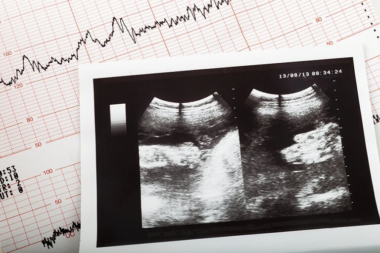 Cardiogram_ultrasound_baby_pregnant_Credit_Aykut_Erdogdu_Shutterstock_CNA.jpg