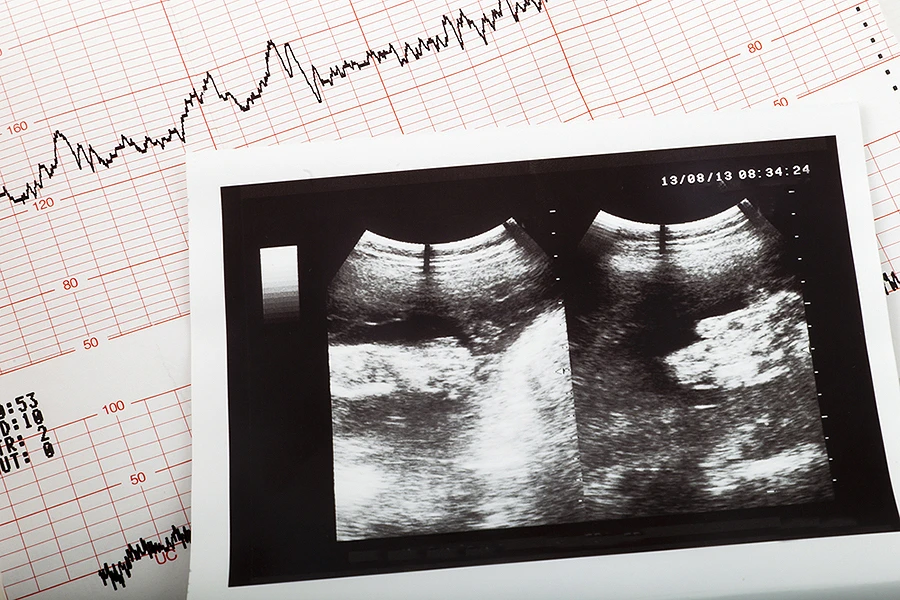 Cardiogram_ultrasound_baby_pregnant_Credit_Aykut_Erdogdu_Shutterstock_CNA.jpg