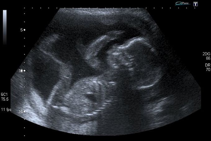 1769142742_Unborn_baby_at_20_weeks_Credit_Steve_via_Flickr_CC_BY_NC_20_CNA.jpg