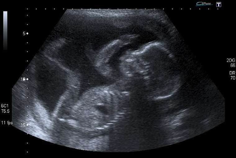 Unborn_baby_at_20_weeks_Credit_Steve_via_Flickr_CC_BY_NC_20_CNA.jpg